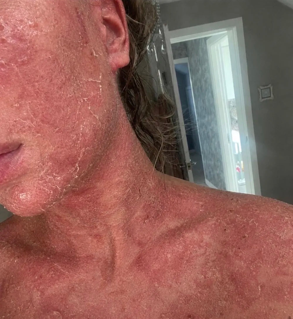 The severe skin condition Kristina lived with